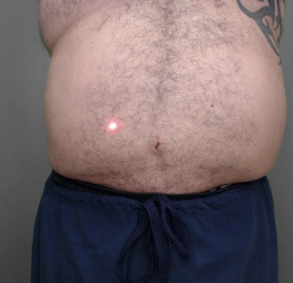 Male torso with tattooed shoulder, hairy abdomen and red laser dot above navel, wearing blue shorts